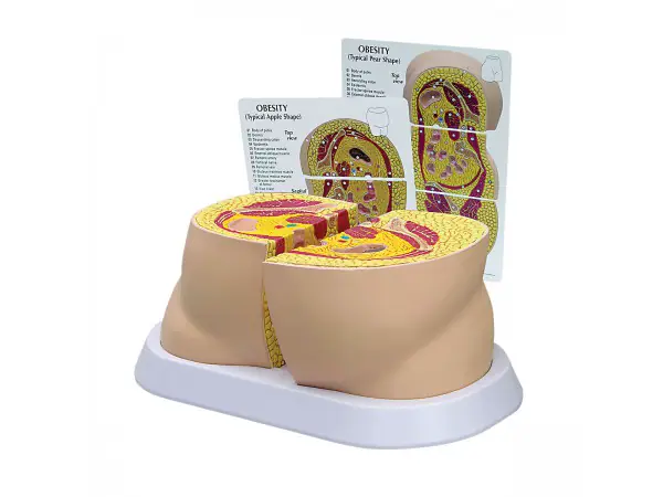 Obesitas model