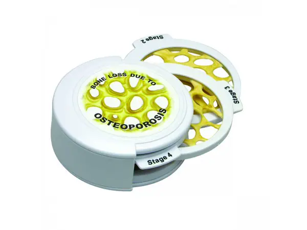 Osteoporose Schijven Set (4 stadia)