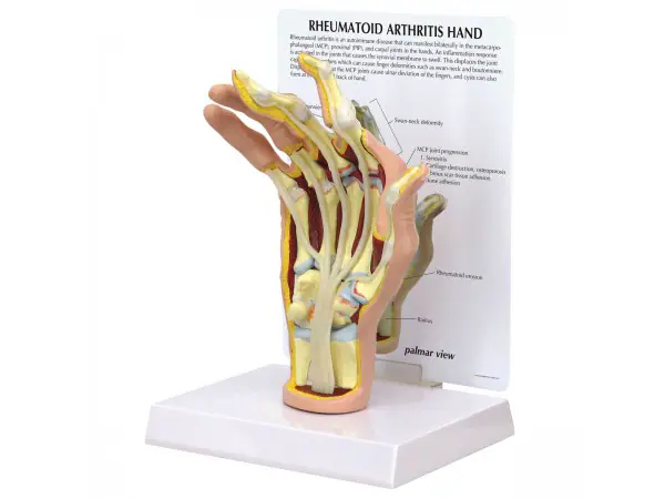 Reumatische Artritis Hand Model