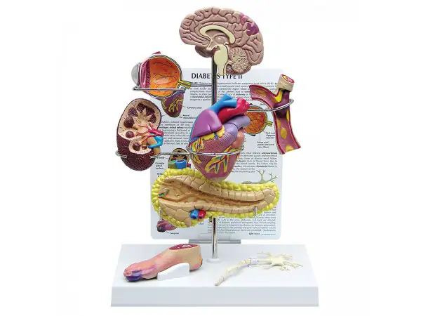 Diabetes Type 2 Model