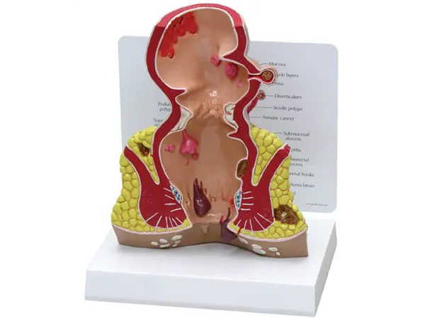 Endeldarm (Rectum), model met infokaart