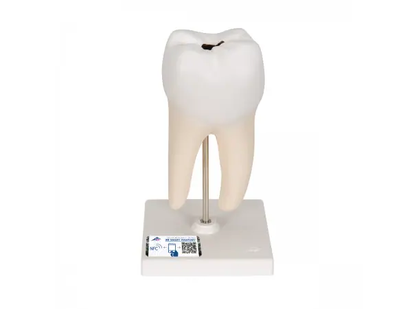 Onderste ware kies met caries 2-delig