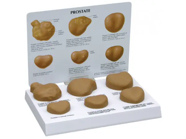Prostaat Model met Ziektes