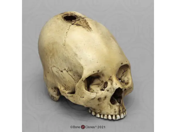 Schedelmodel Trepanatie