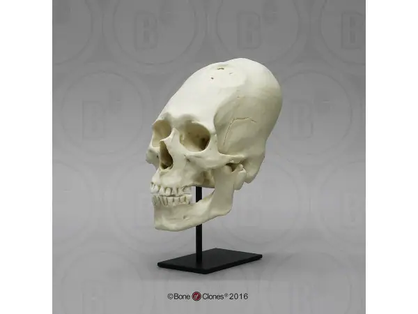 Mannelijk Model Schedelbinding en Trepanatie
