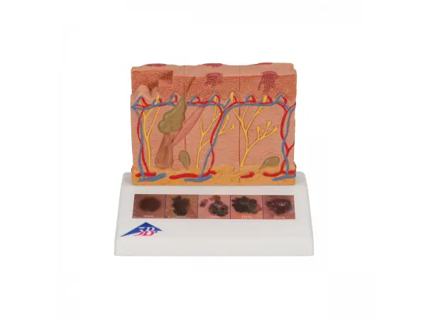 Huidkanker model