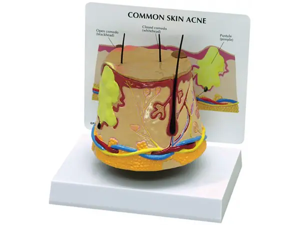 Huid acné model + infokaart