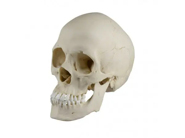 Scaphocephalische Schedel