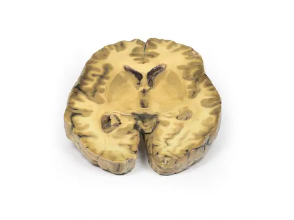 Ventriculitis, secundair aan bloedvergiftiging, 3D Print