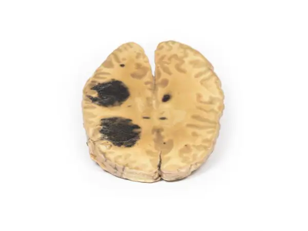 Hersenbloeding, secundair aan AML, 3D Print
