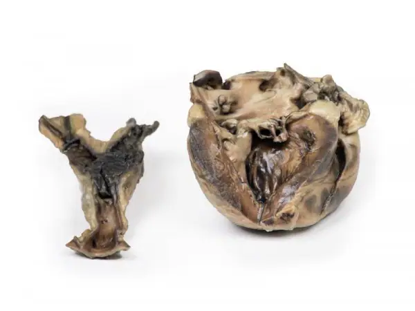 Hydatide Cysten, die het hart en de aorta aantasten, 3D Print