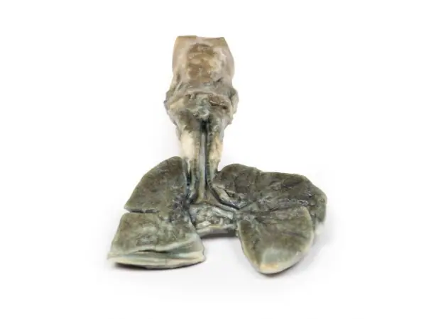 Tracheoesofageale Fistel en Oesofagusatresie, 3D Print