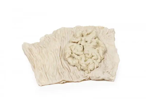 Villeus Adenoom in Dikke Darm, 3D Print