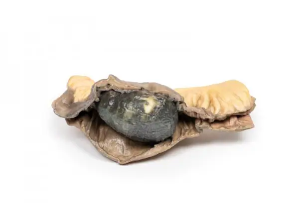 Galsteenileus, 3D Print