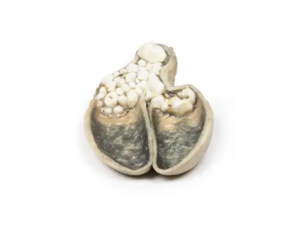 Cholecystitis en Cholelithiasis, 3D Print