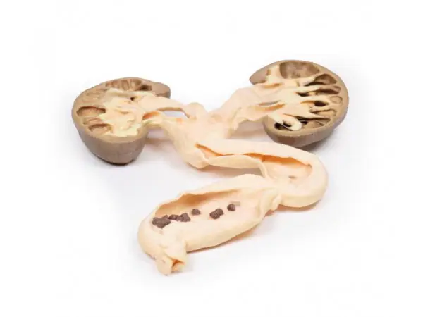 Hydronefrose en Hydro-ureter, 3D Print