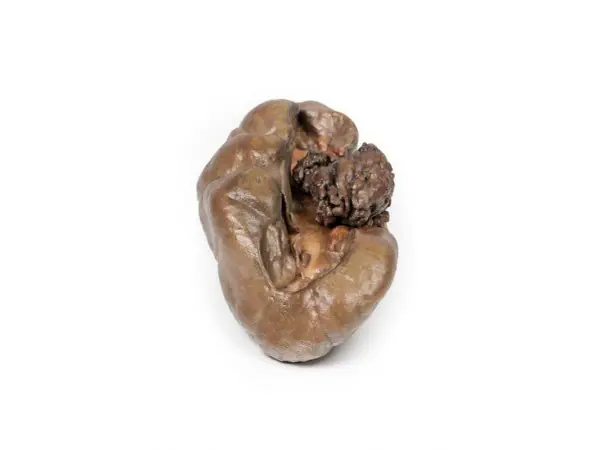 Papillair Overgangscelcarcinoom in het Nierbekken, 3D Print