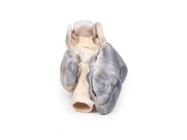 Retrosternaal Struma, 3D Print