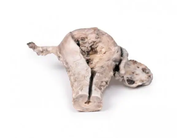 Endometriumcarcinoom, 3D Print