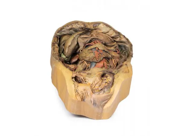 Buik met Liesbreuk, 3D Print