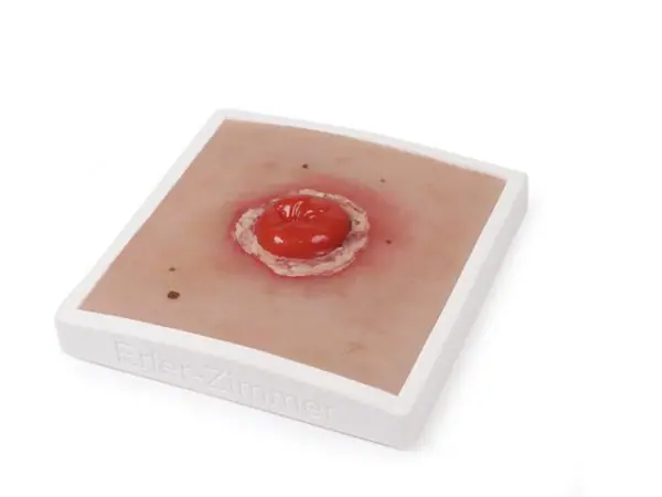 Colostoma met Ontsteking Model