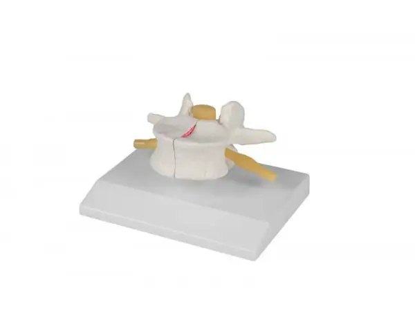 Wervel Model met Osteoporose, 2 x ware grootte