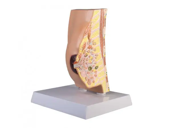 Doorsnede Borst Model met Ziektes