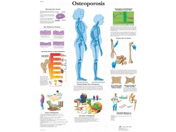 Osteoporosis, papieren wandplaat