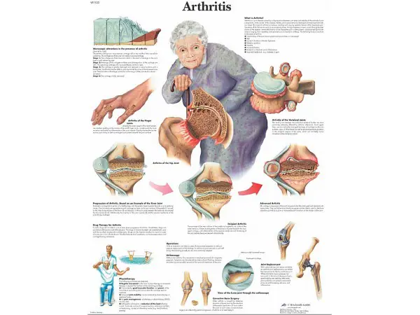 Arthritis, gelamineerde wandplaat