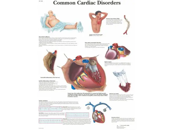 Anatomie Poster Hartziektes, gelamineerd
