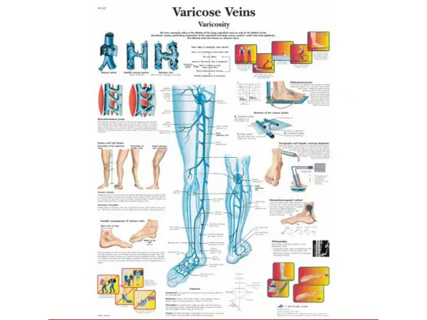 Anatomie Poster Varicose Veins (spat-aderen), gelamineerd
