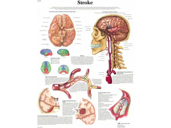 Anatomie Poster Hersenbloeding, gelamineerd