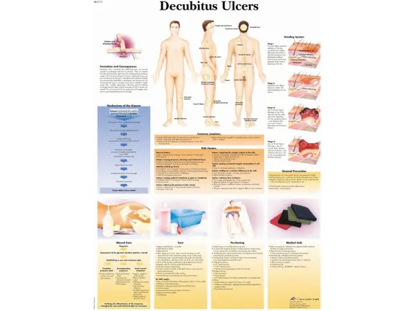 Anatomie Poster Decubitus, papier