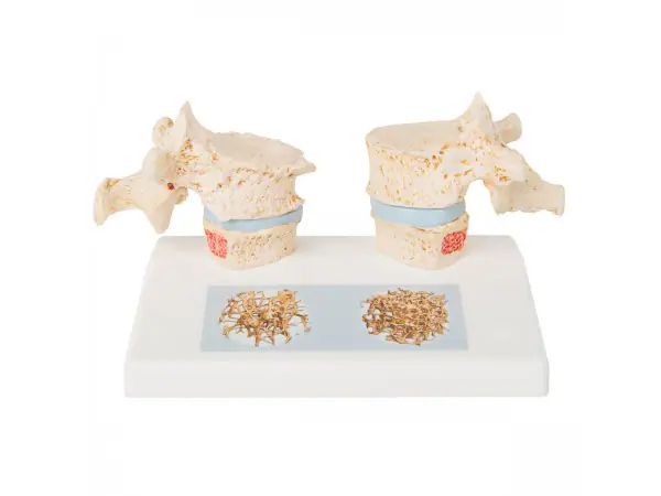 Osteoporose model