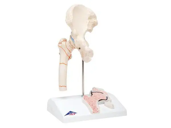Dijbeenbreuk en hiposteoarthritis