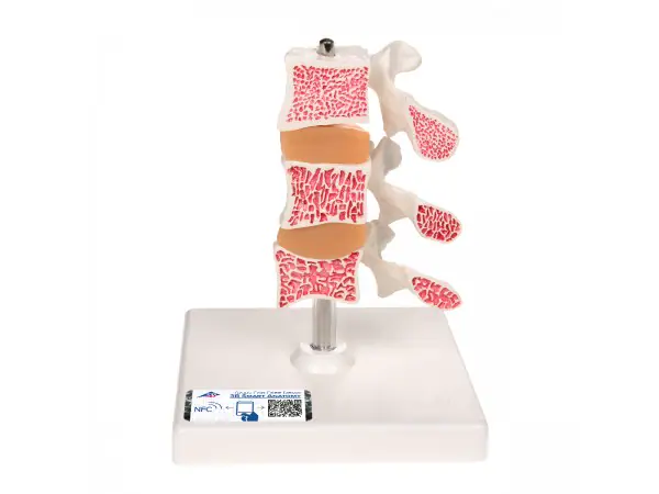 Deluxe Osteoporose model