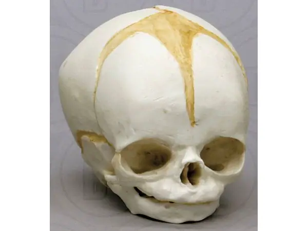 Schedel foetus 32 weken