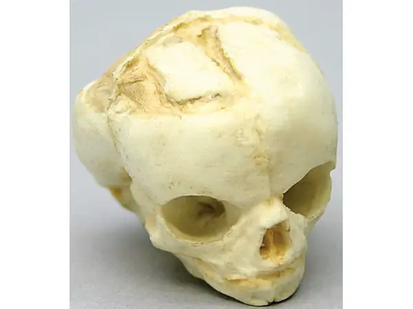 Foetus schedel 17 weken