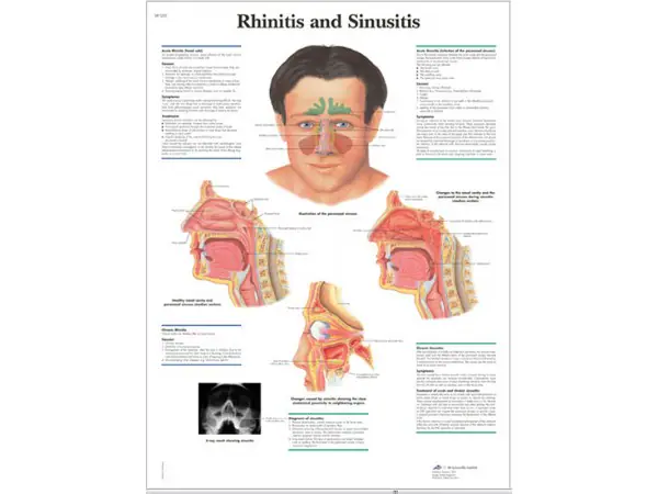 Rhinitis & Sinusitis, papieren wandplaat