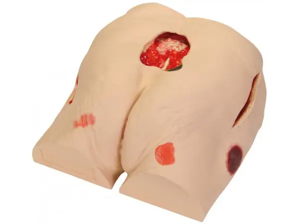 Decubitus (Ulcus) model