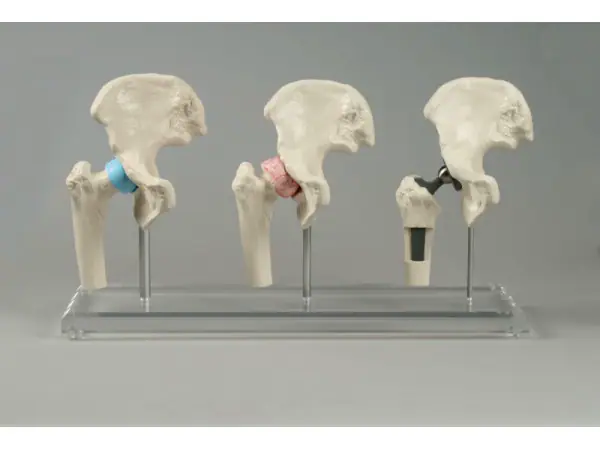 Heupimplantaat Model