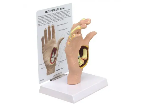 Anatomisch Model Osteoartritis Hand
