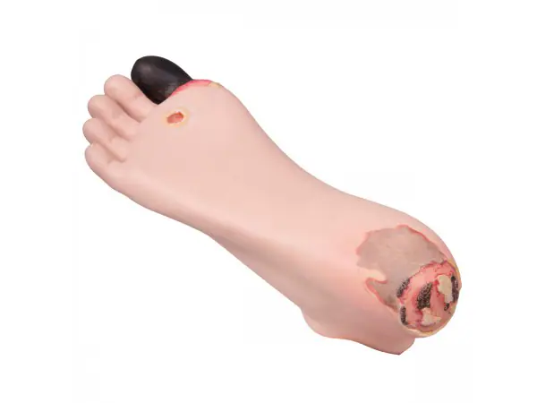 Diabetes Voetmodel